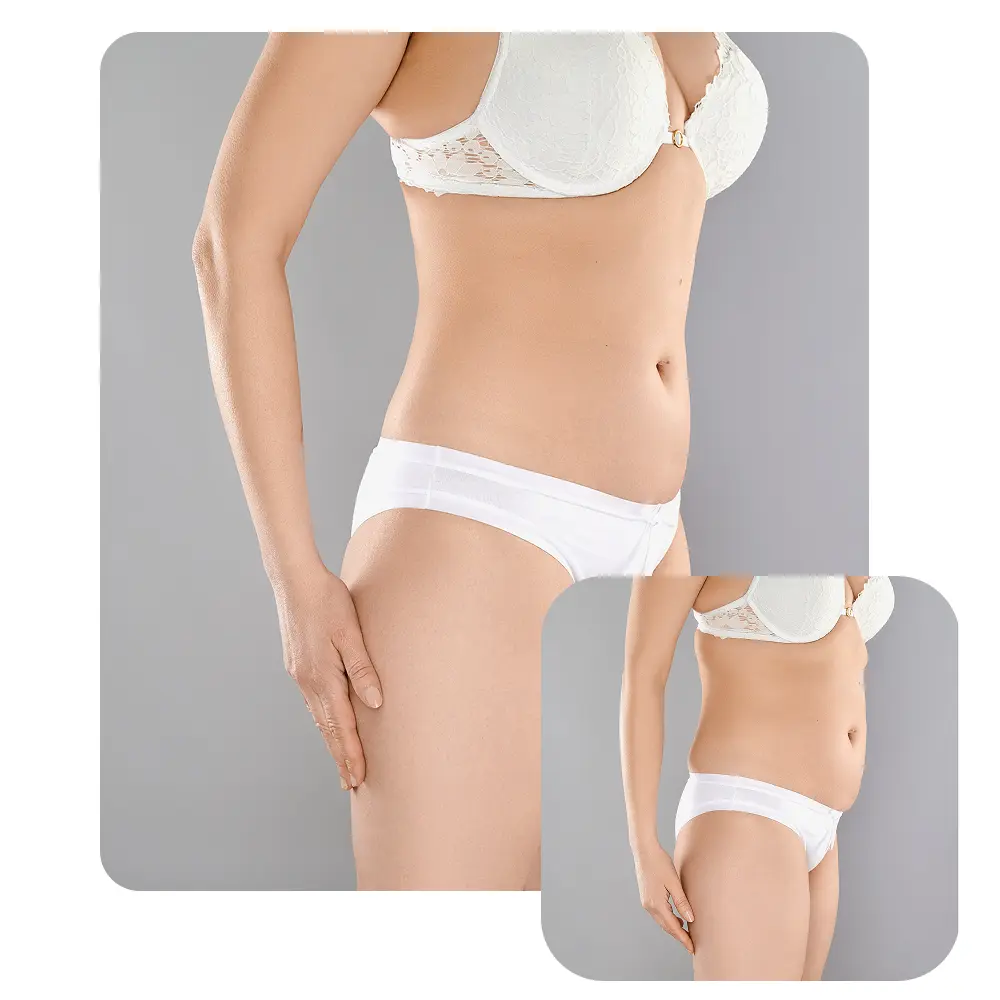 before-after-liposuction-2