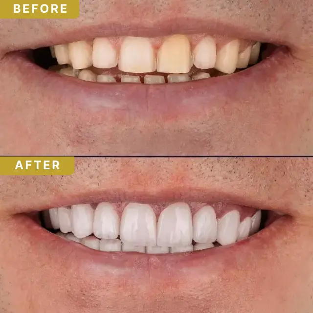 dental-implant-baf-1