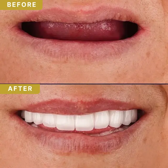 dental-implant-baf-2