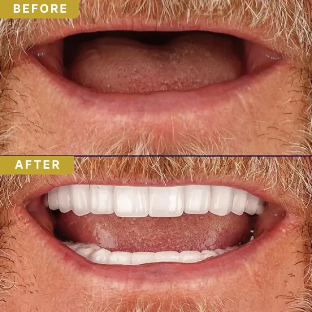 dental-implant-baf-3