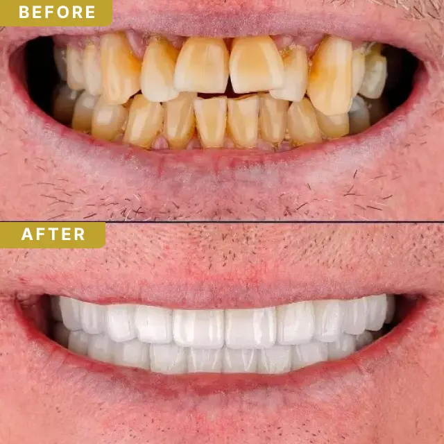 dental-implant-baf-4