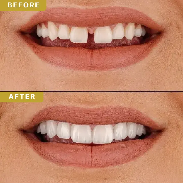 hollywood-smile-baf-1