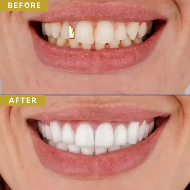 hollywood-smile-baf-2